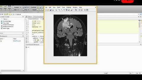 Brain Tumor Segmentation Using K Mean Algorithm | Image Processing