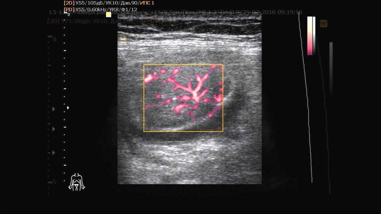 Узи кишечника как подготовиться. Новообразование кишечника на УЗИ. Ультрасонография Толстого кишечника.