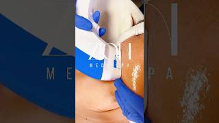 HIFU SMAS Lifting Treatment (Shrink Universe) | NJ V-Line Facelift