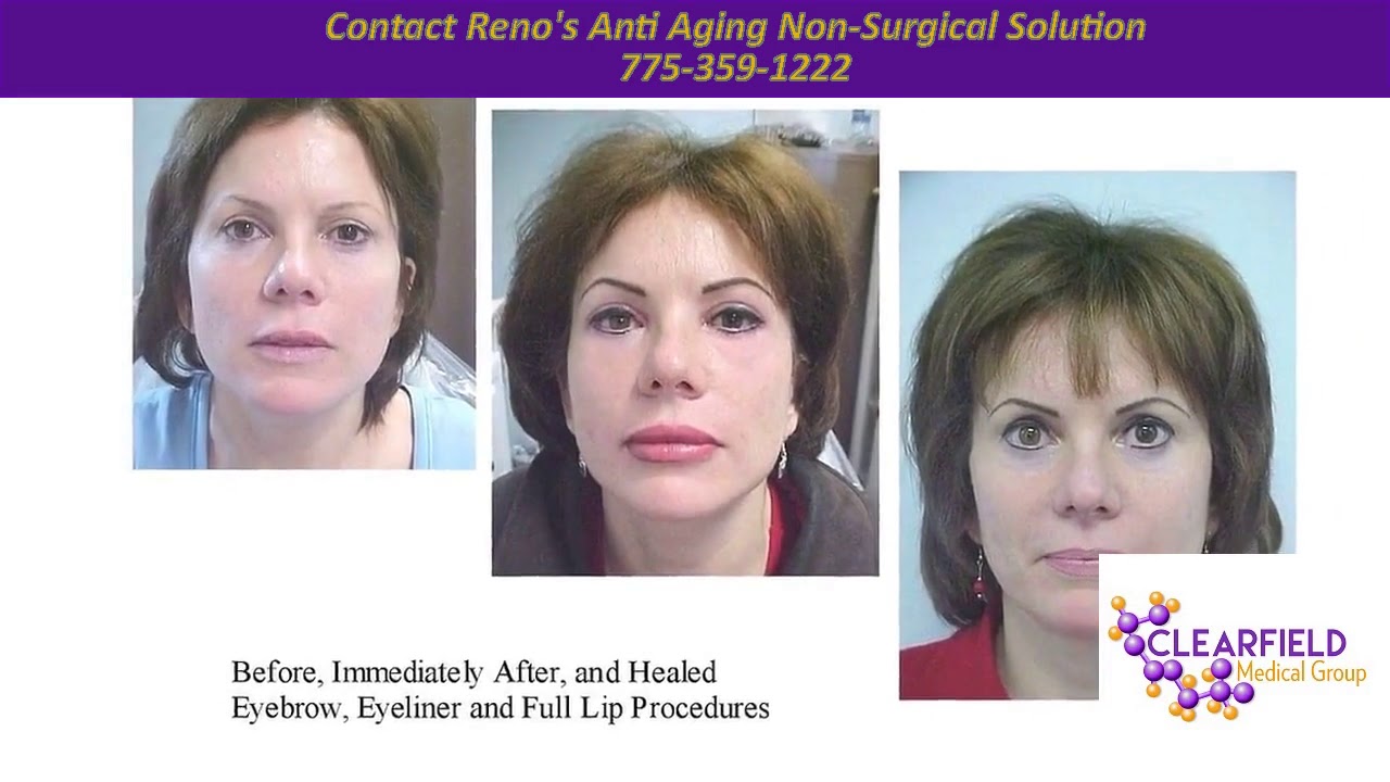 Reno Doctor Lip Augmentation Before And After in Reno Nv YouTube