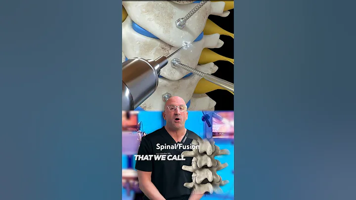 Can Spinal Fusion Lead to MORE Spine Surgery? #shorts