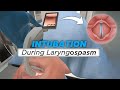 Intubation during laryngospasm