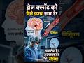 brain mai jamne waale clot ko kaise hataya jaata hai 3D process#anatomy