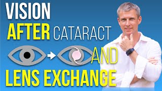 Cataract surgery - vision quality realistic expectations