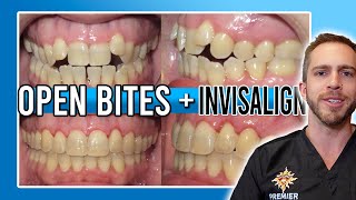 Invisalign Open Bite Treatment! [BEFORE & AFTER]