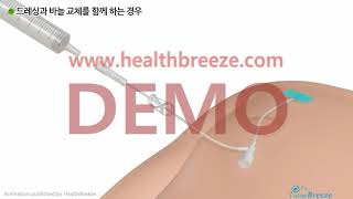 [Demo] g0070aako_Guide to Chemoport Use and Management (For Nursing Facilities)
