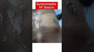 Dressing removal & RF Massage after Gynecomastia surgery shorts