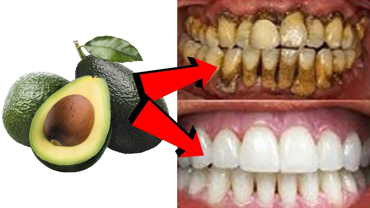 MAGICAL TEETH WHITENING REMEDY || NATURAL HOME REMEDY - YouTube