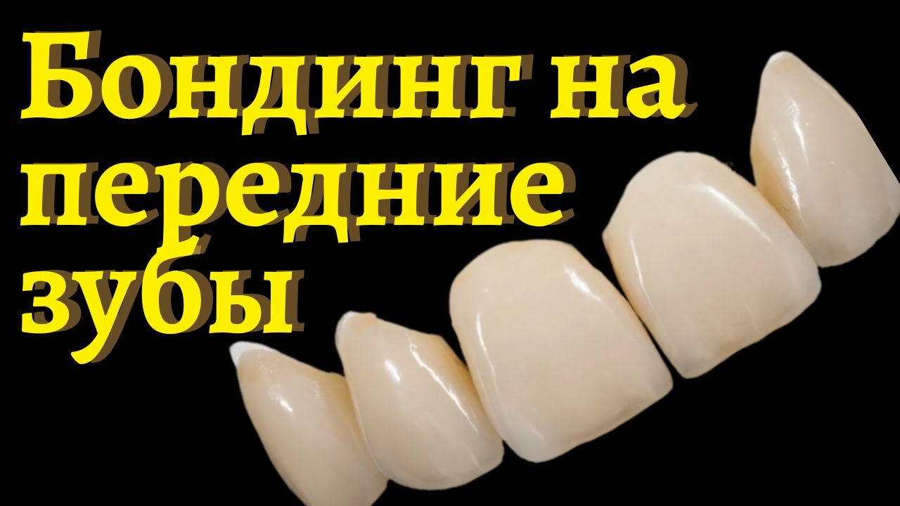 [Передние зубы - бондинг] Эстетическая реставрация зубов: так можно восстановить передний зуб!
