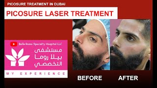 PicoSure Laser Treatment | PicoSure Procedure Bella Roma Dubai