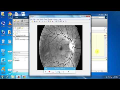 IEEE 2015 MATLAB SPARSE DISSIMILARITY CONSTRAINES CODING FOR GLAUCOMA