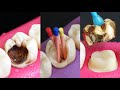 Classic Restoration Of Decayed Tooth By Root Canal And Gold Crown Classic Restoration Of Decayed Tooth By Root Canal And Gold Crown