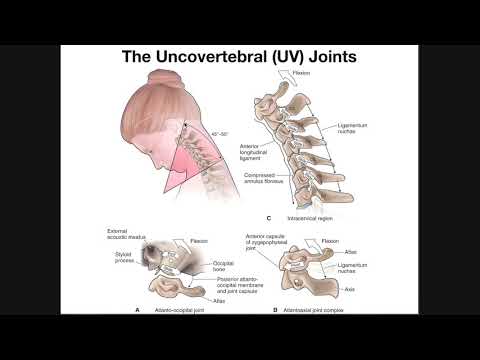 Video: Uncovertebral Arthrosis - Treatment, Arthrosis Of The Cervical Spine