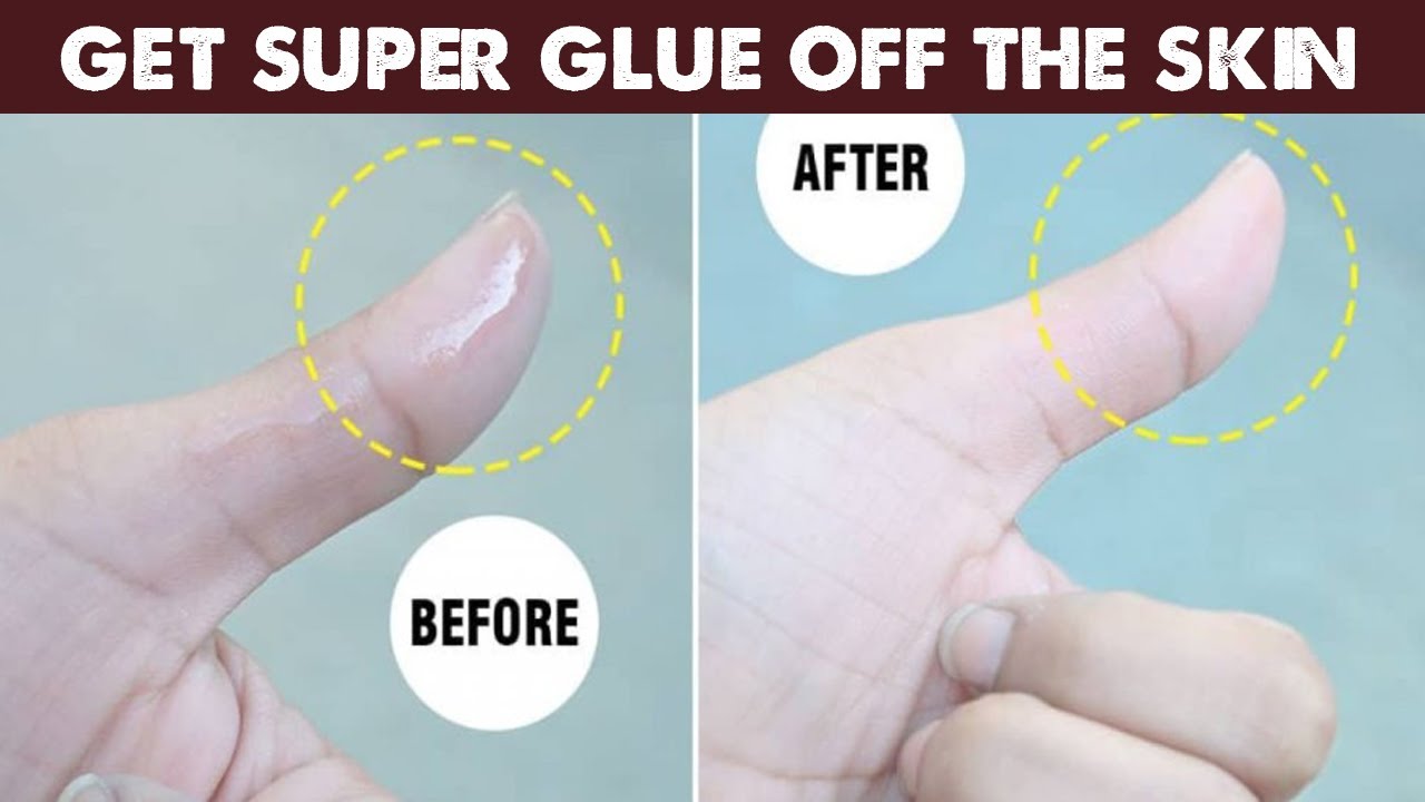 How to remove super glue from skin hands and finger YouTube