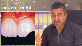 Ask Dr Atef 2022 - علاج كسور الأسنان