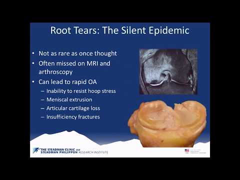 What is a Meniscus Root Tear? | Why Repair a Meniscus Root Tear? | Knee Surgeon | Minneapolis, MN