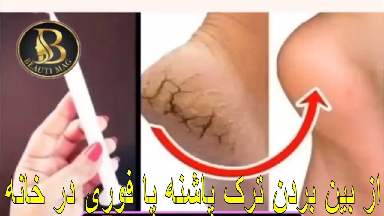 از بین بردن ترک پاشنه پا فوری و بسیار آسان در خانه