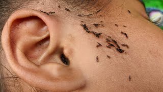 Head lice Removal from hair - Getting out all of hundred lice from hair