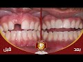 تعويض سن مفقود بجسر الفراشه تجميل الاسنان 