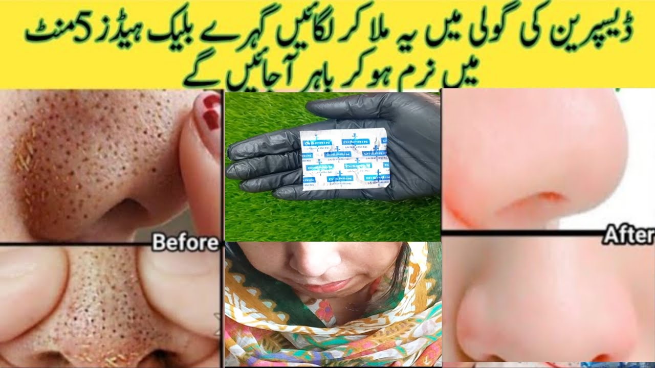 Photo inspiration: How To Remove Blackheads At Home Im 2 Mimutes Photo Inspiration