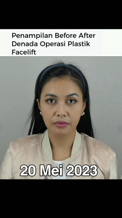 Inilah Wajah Denada Setelah Operasi Plastik! #denada #operasi #korea #shorts