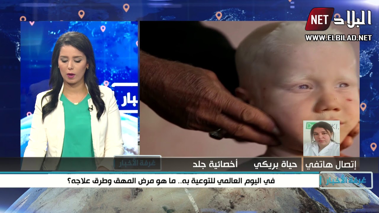 في اليوم العالمي للتوعية به    ما هو  مرض المهق وطرق علاجه ؟