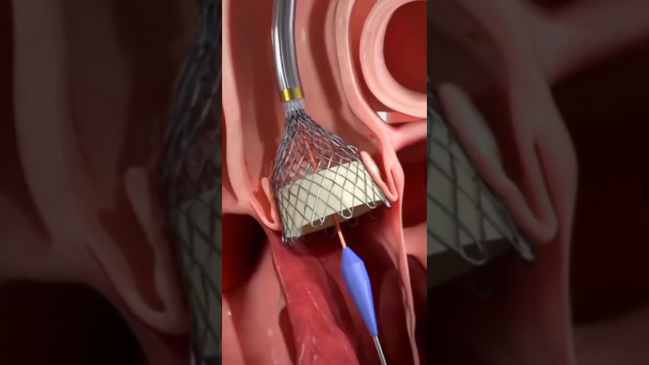 Transcatheter Aortic Valve Implantation Procedure TAVI 