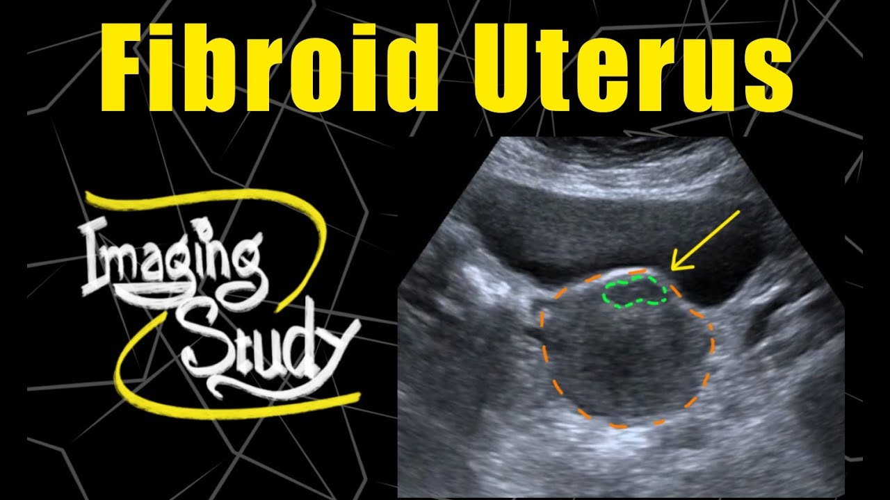 case study on fibroid uterus