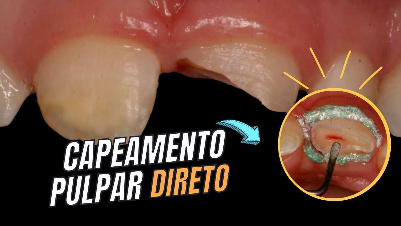 Capeamento Pulpar Direto Passo A Passo - RETOEDU