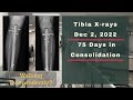 Height Journey - Tibia X-rays 75 Days In Consolidation - Dec 2, 2022