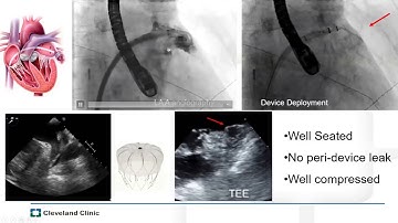 LAA Closure: Addressing the Unmet Needs for AF Patients