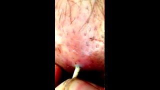 botfly removal extraction quick