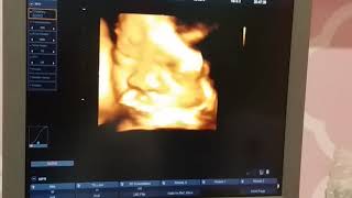USG 4D Usia kehamilan 32 minggu