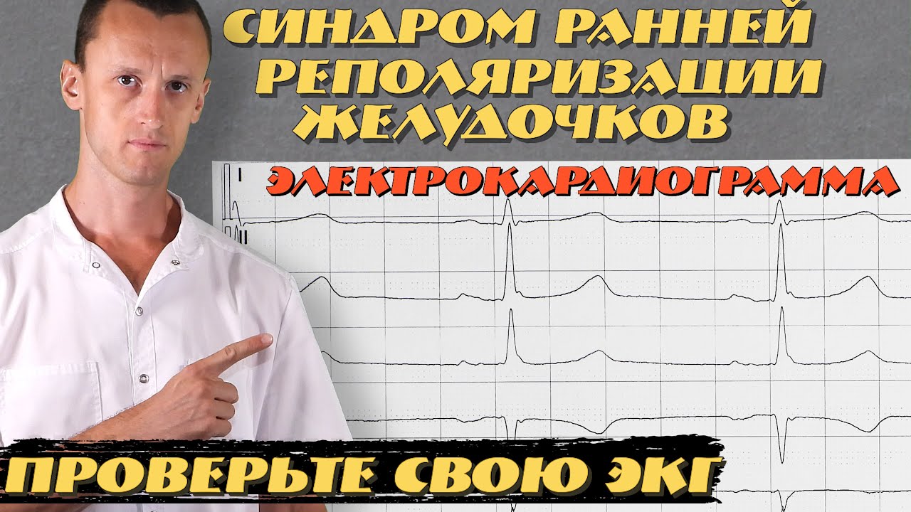 Синдром ранней реполяризации желудочков | ЭКГ - YouTube
