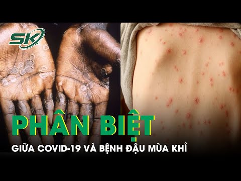 Cách Phân Biệt Đơn Giản Nhất Giữa Phát Ban Covid-19 Và Đậu Mùa Khỉ