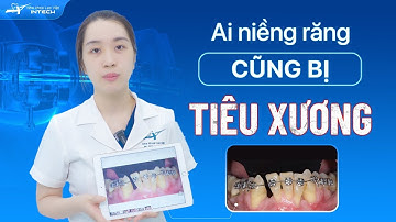 Tiêu Xương Răng: Tiêu Xương Răng Xảy Ra Khi Nào? Làm Sao Để Phòng Tránh Tiêu Xương Răng Khi Niềng