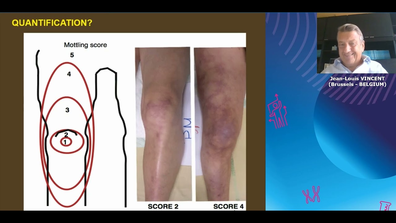 Capillary refill time J L Vincent 2021 YouTube