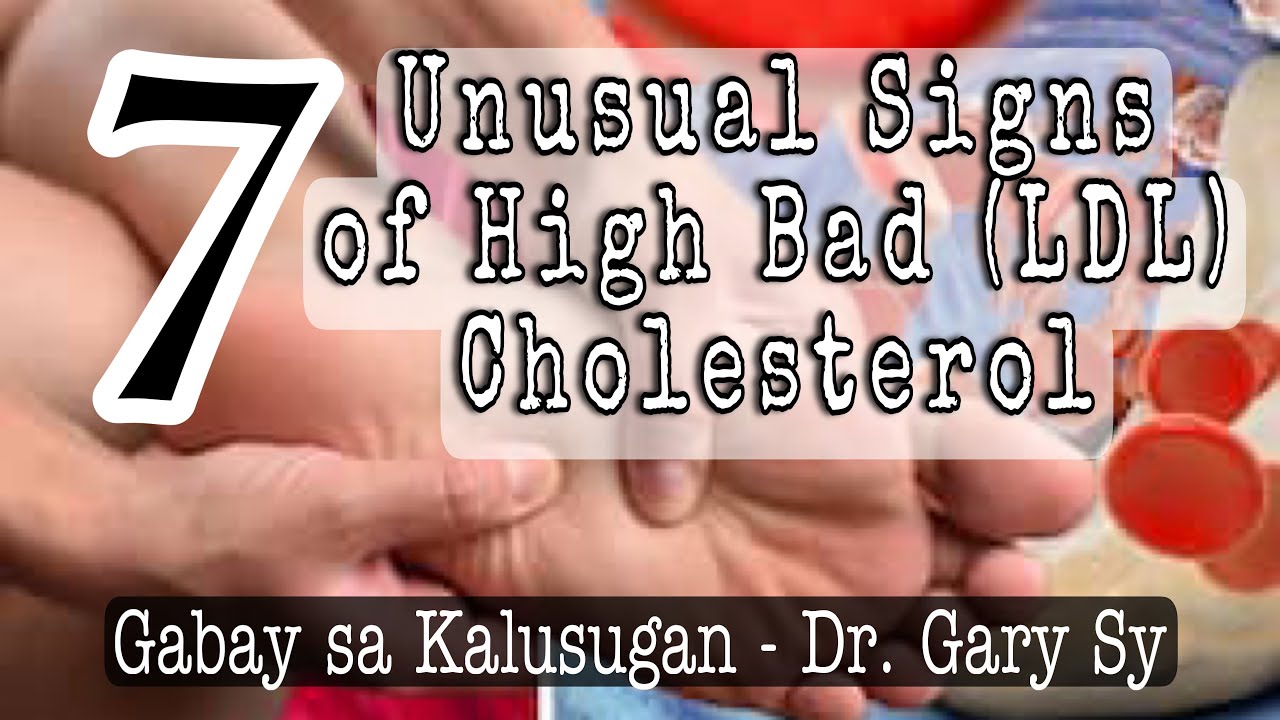 SENYALES SA MGA PAA AT BINTI NA MATAAS ANG CHOLESTEROL NIYO! 7 Unusual Signs of High Bad Cholesterol