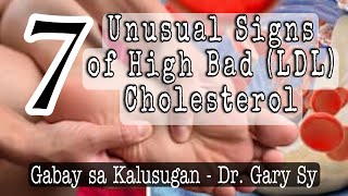 SENYALES SA MGA PAA AT BINTI NA MATAAS ANG CHOLESTEROL NIYO! 7 Unusual Signs of High Bad Cholesterol