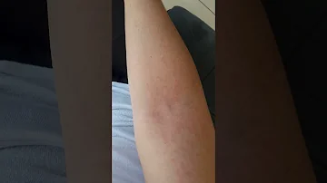 Como diagnosticar a doença de Lyme?