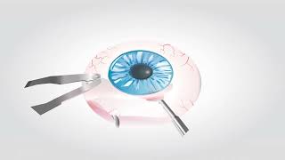 SIGS - STAB INCISION GLAUCOMA SURGERY schematic