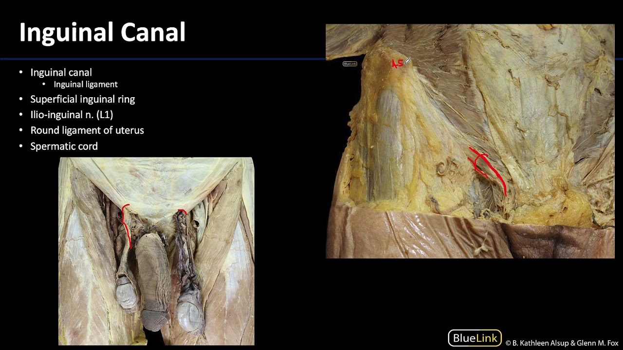 Transumbilical endoscopic technique for complete closure of inguinal  hernias in female pediatric patients