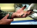 Hand Burnt in Tar - Part 1 - Bizarre ER