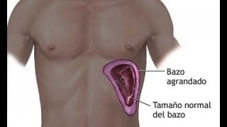 Vaso localizada dilatación un anormal sanguíneo de