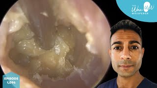 1,096 - Complex Swollen & Infected Ear Wax Removal