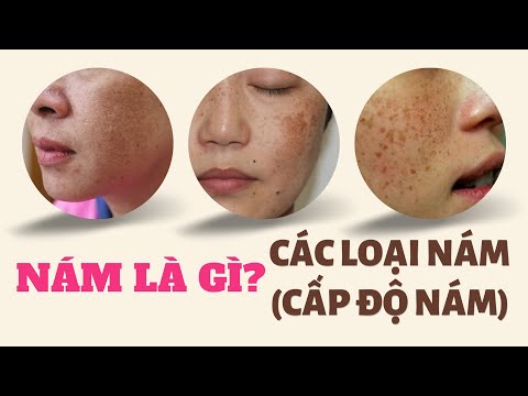 Nám da mặt