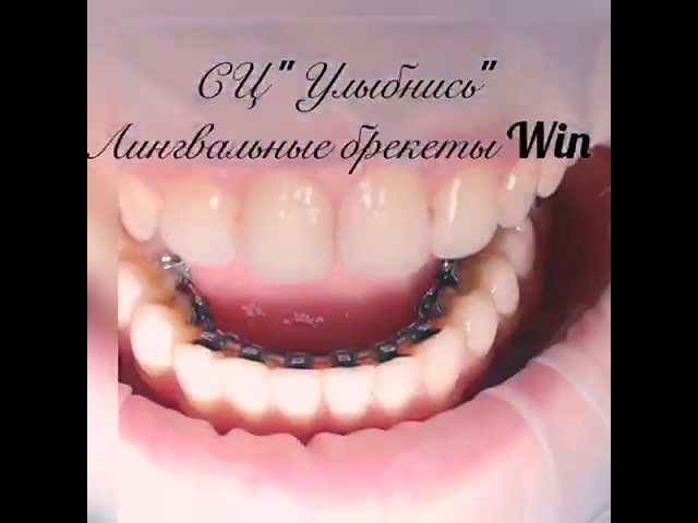 Лингвальные брекеты. Win. Ортодонт. Исправление прикуса с помощью брекетов.