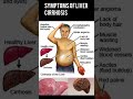 signs and symptoms of Liver cirrhosis/Liver cirrhosis/jigar ke bemari#livercirrhosis #shorts