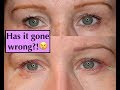 Blepharoplasty Experience UK (Eyelid Surgery|Hooded Eyes)  - 1 Wk/Stitches Removed