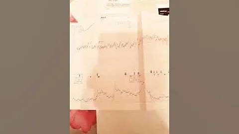 расшифровка ктг на моем примере как распознать гипоксию плода тонус матки схватки